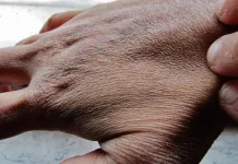 Pele ressecada? Inverno exige cuidados especiais