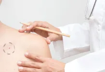 Tecnologia para tratar câncer de pele é aprovado para uso no SUS