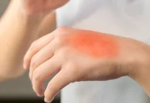 Queimaduras: saiba o que fazer