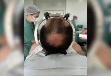 Microchip cerebral para tratamento de TOC é implantado em SC