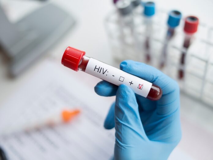 Nova variante do HIV é identificada em três estados brasileiros