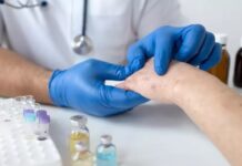 Santa Catarina em alerta com 10 casos confirmados de mpox