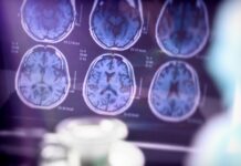 Cientistas brasileiros descobrem substância para tratamento do alzheimer