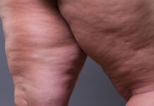 Lipedema: A doença pouco conhecida que afeta milhares de mulheres