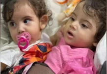 Gêmeas siamesas brasileiras são separadas após 19 horas de cirurgia