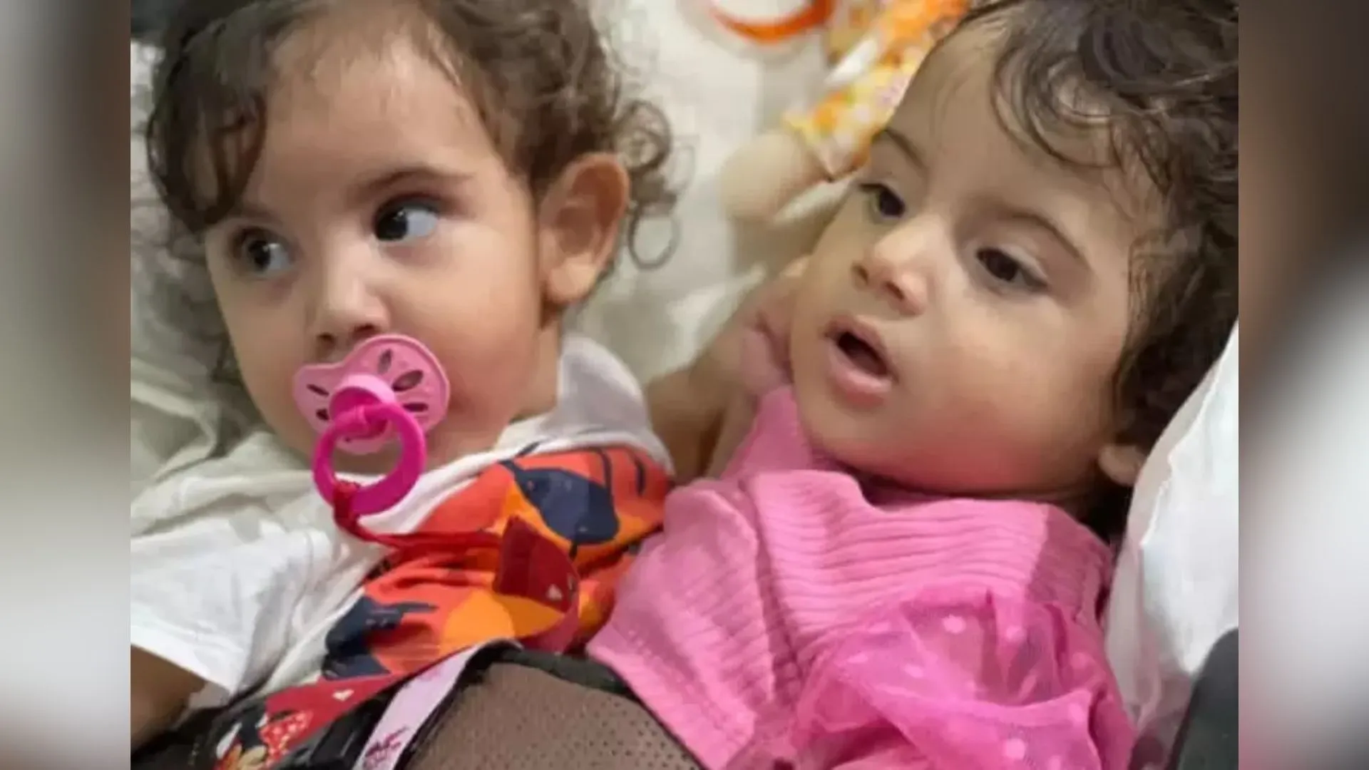 Gêmeas siamesas brasileiras são separadas após 19 horas de cirurgia