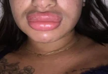 Falsa biomédica é investigada em SC por deformar pacientes