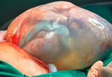 Dois bebês nascem empelicados em apenas 48 horas em SC