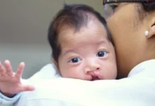 Fissura palatina em bebês: SC torna exame obrigatório nas primeiras 48 horas