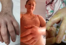 Agricultora picada por jararaca revela detalhes da recuperação