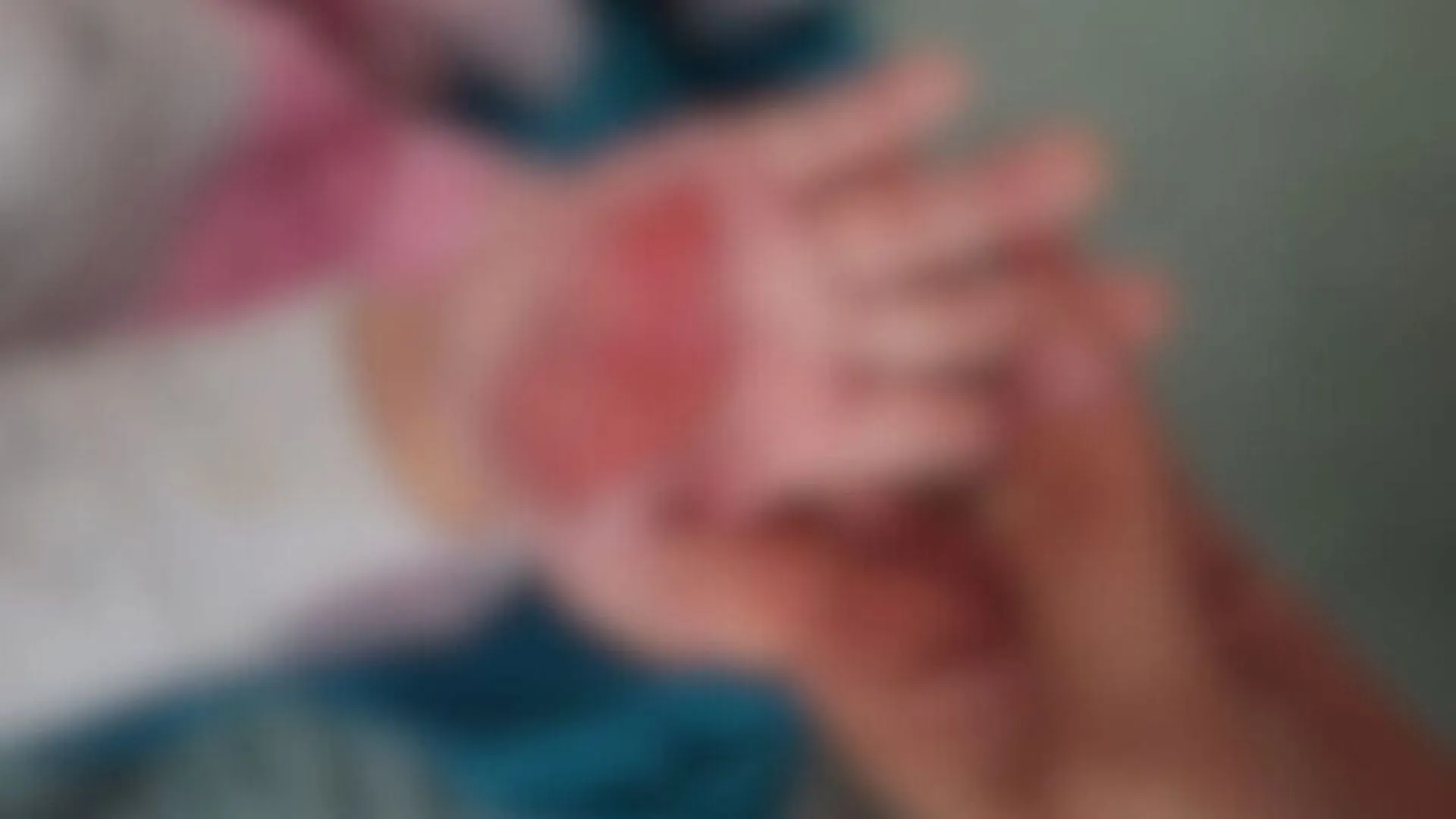 Madrasta queima mão de criança de 2 anos como castigo