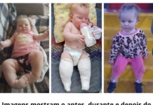 Hospital Maice amplia atendimento a crianças com pé torto congênito