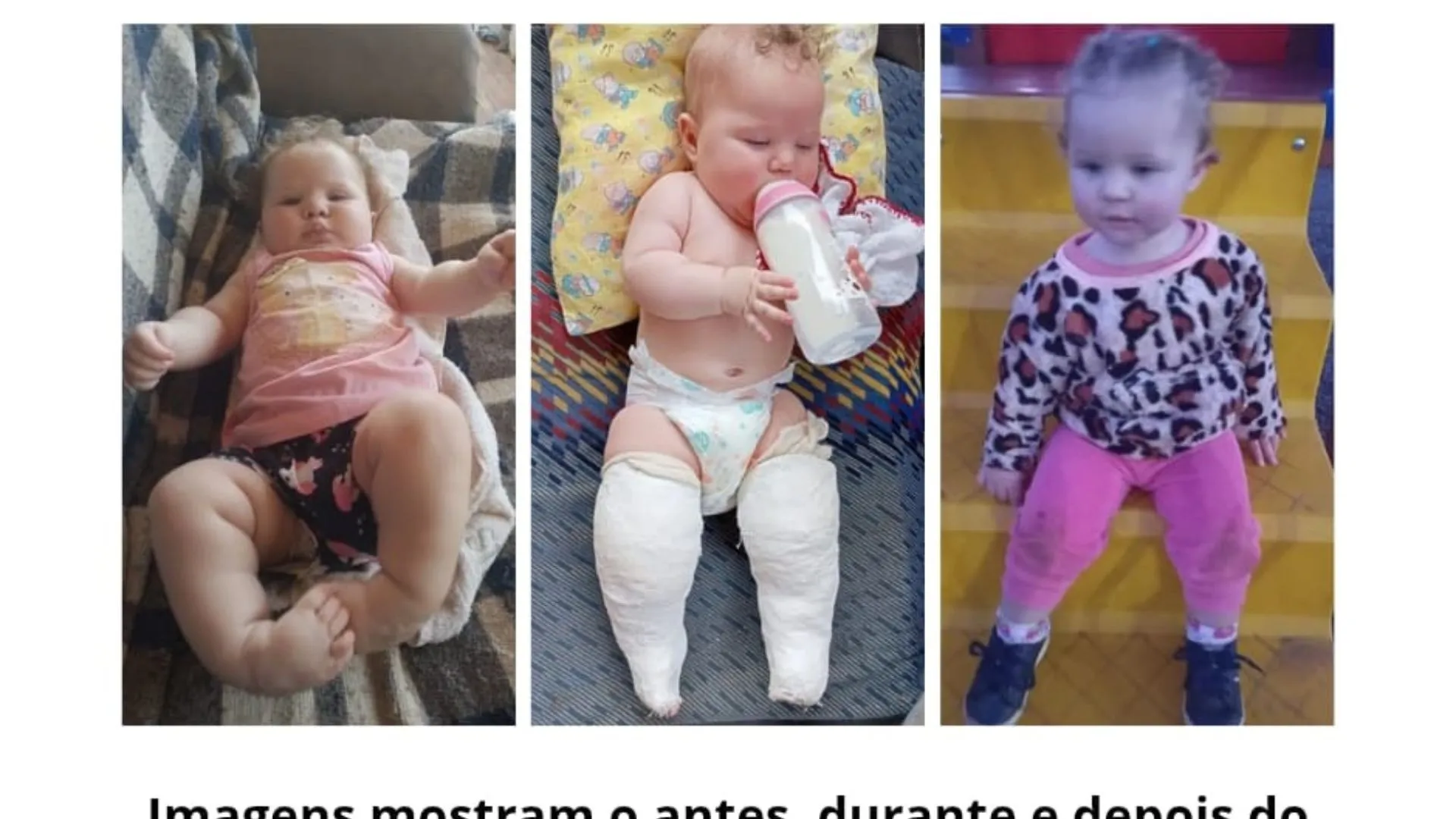 Hospital Maice amplia atendimento a crianças com pé torto congênito