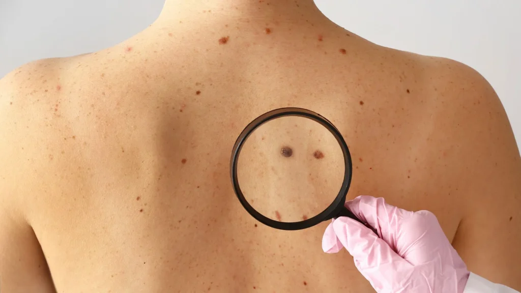 Santa Catarina lidera casos de melanoma e reforça importância da prevenção