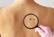 Santa Catarina lidera casos de melanoma e reforça importância da prevenção