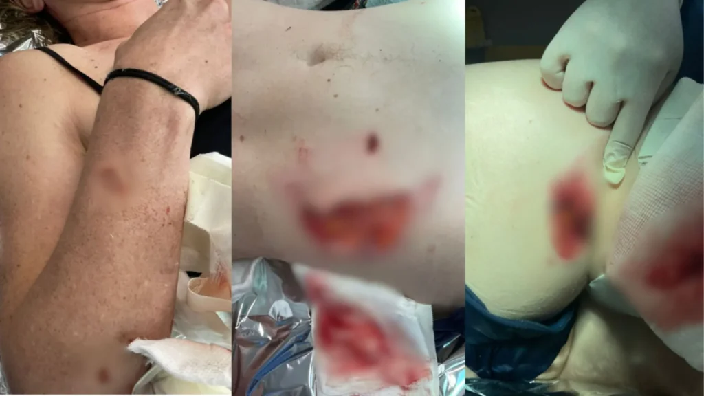 Mulher atacada por capivara tem partes do corpo arrancadas em SC