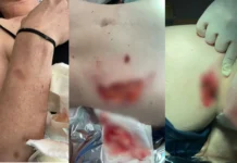 Mulher atacada por capivara tem partes do corpo arrancadas em SC