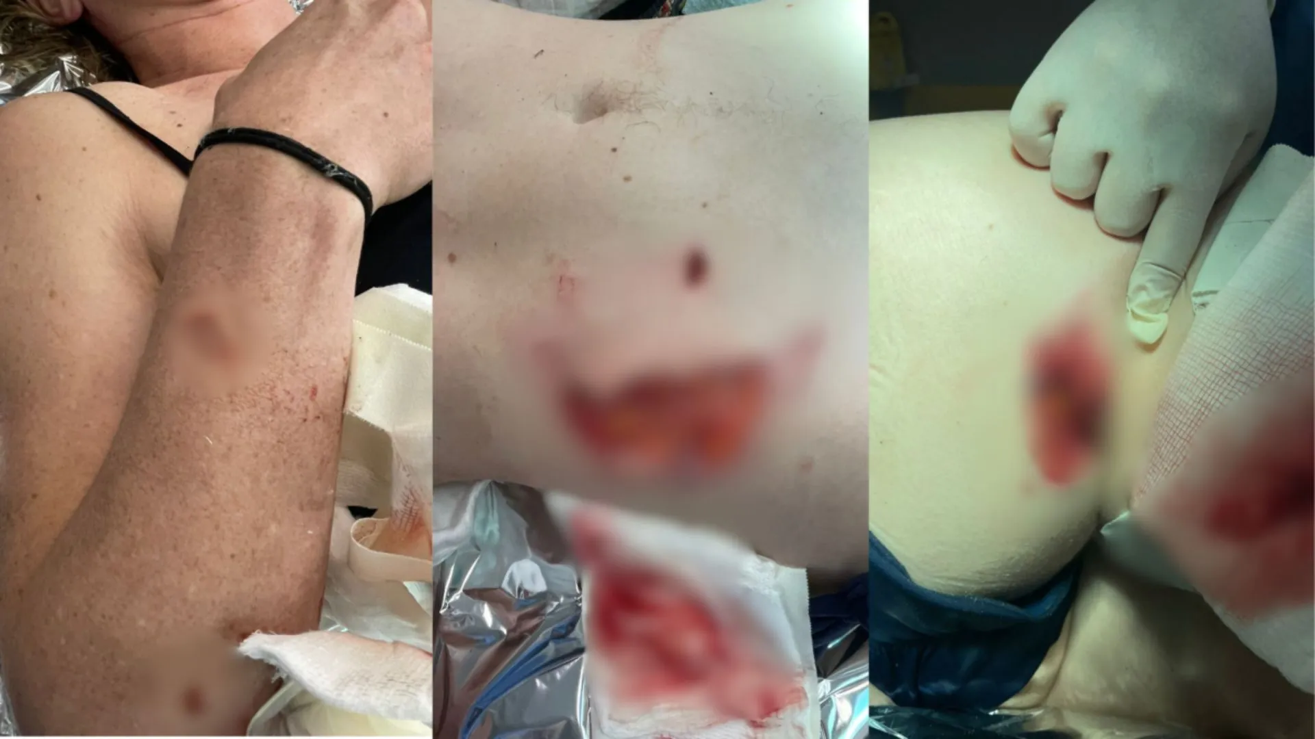 Mulher atacada por capivara tem partes do corpo arrancadas em SC