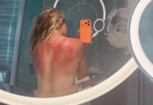 Tenista expõe queimadura solar e alerta para risco do calor na Austrália