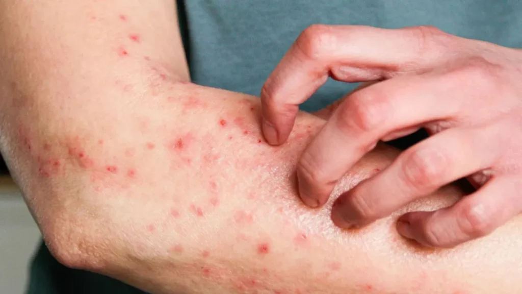 Brasil registra 81 casos de Mpox em 2026; veja os estados com casos