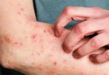 Brasil registra 81 casos de Mpox em 2026; veja os estados com casos