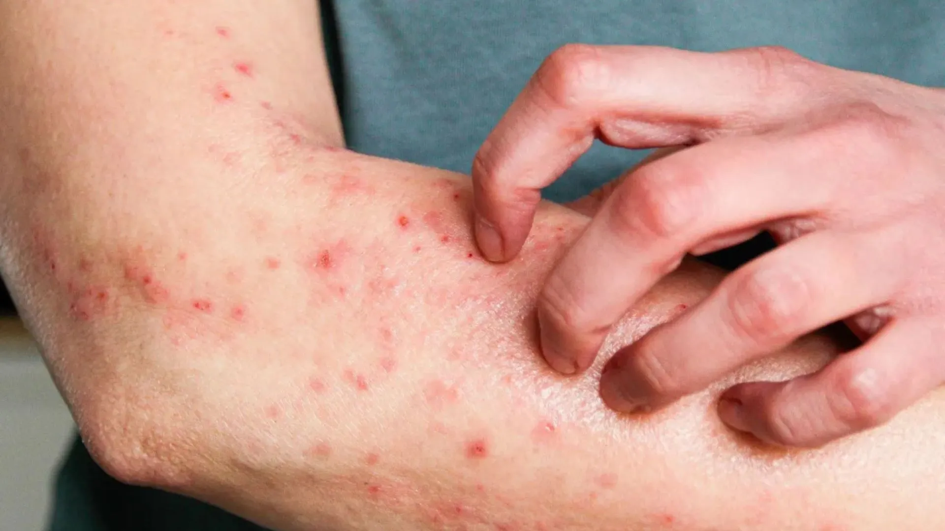 Brasil registra 81 casos de Mpox em 2026; veja os estados com casos