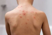 Santa Catarina investiga 16 casos suspeitos de Mpox