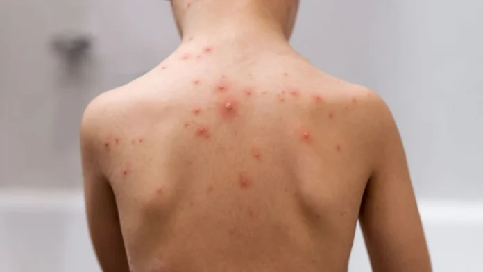 Santa Catarina investiga 16 casos suspeitos de Mpox