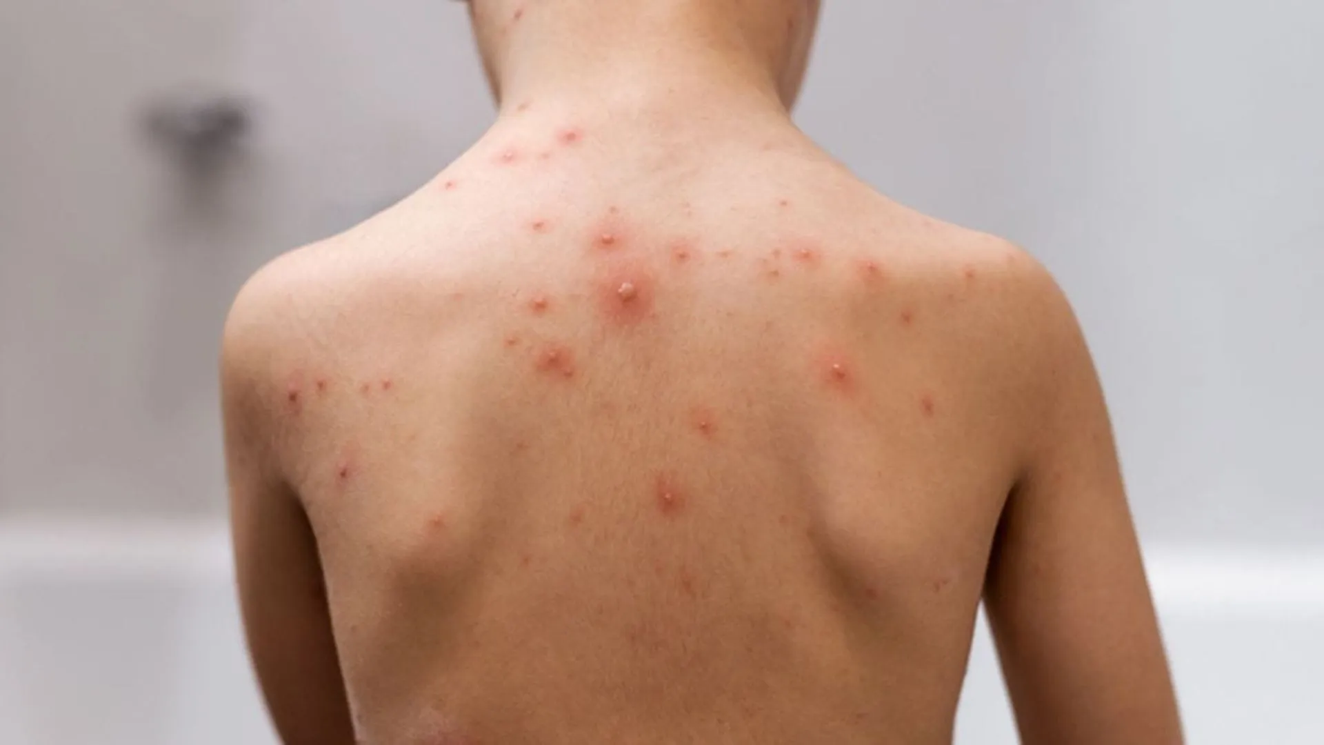 Santa Catarina investiga 16 casos suspeitos de Mpox