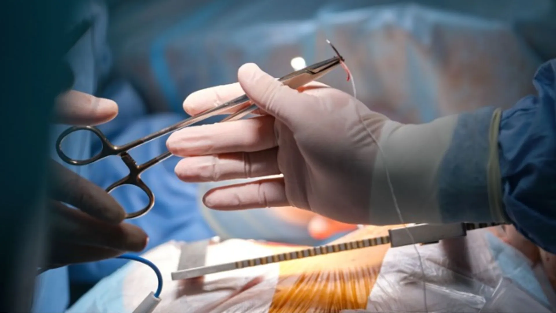 Mulher será indenizada após 5 anos com objeto esquecido no corpo