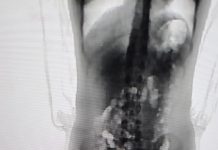 Adolescente de 13 anos tenta entrar em presídio de SC com 32 porções de skank escondidas no corpo Adolescente tenta entrar com droga dentro do corpo em prisão de SC